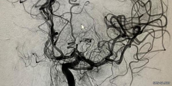 نجاح قسطرة دماغية تداخلية لمريض في مستشفى عسير المركزي