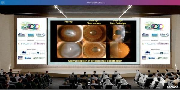 بدء أعمال اجتماع طبّ العيون السعودي 2020 والمعرض الطبي الافتراضي المصاحب له