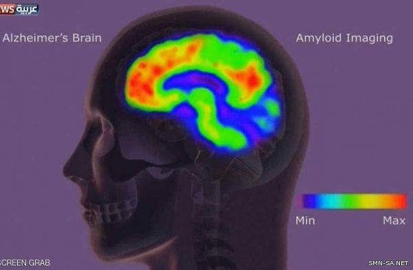 أوروبا تضع خططا لعلاج ألزهايمر في مراحله المبكرة