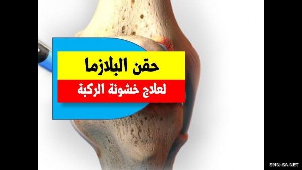 تقنية حقن البلازما لعلاج خشونة المفاصل