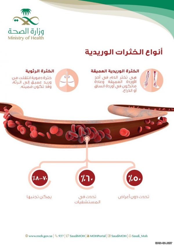 الصحة تحذر من الخثرات الوريدية: 50 % منها تحدث دون أي أعراض